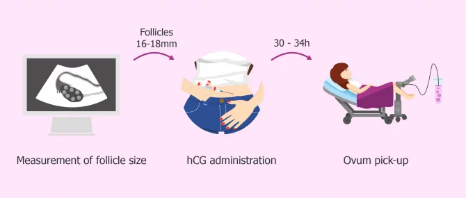 بازیابی تخمک