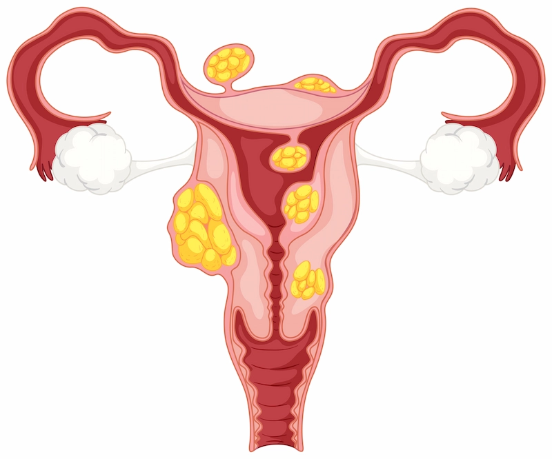 IVF for PCOS Patients in Iran: A Specialized Protocol for High Success & Safety